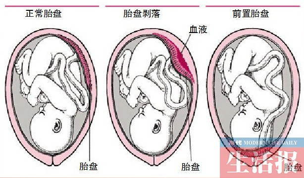 女子怀二胎36周查出凶险型前置胎盘怀二孩要当心 广西新闻 贺州新闻网