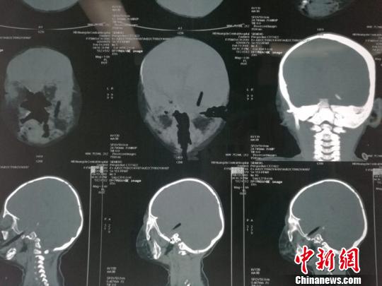 薛源)24日晚上10时,神情紧张的何先生抱着孩子冲进武汉儿童医院急诊室