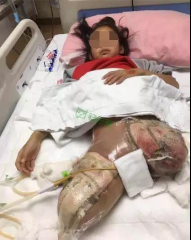 8岁女孩柳州柳石路上学途中遭货车碾压双腿截肢