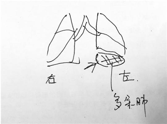 杭州7岁男孩长3个肺 专家:会影响正常呼吸