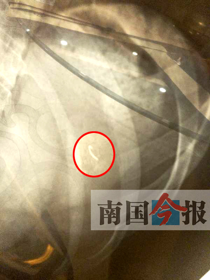 顾客称误吞鱼钩向饭店索赔近万元 但表现颇为蹊跷