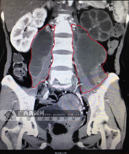 患者脊柱的术前医学影像图(两侧腰大肌旁巨大脓肿).