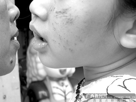 看着左脸满是伤痕,差一个月就满3岁的女儿琪琪,父母很是心痛