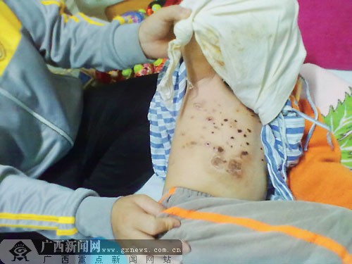 小杰全身多处受伤,存在感染风险.见习记者 陈素雅摄