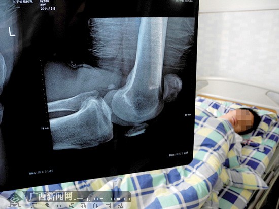 覃某躺在病床上,拍片显示左腿膝盖骨折.记者 程浩楠摄