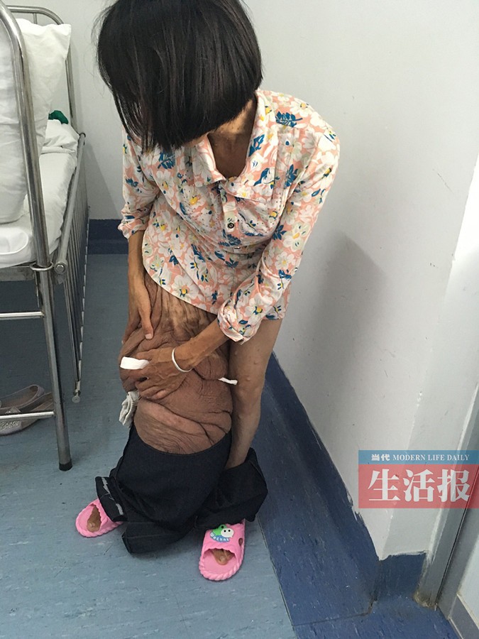 因经济拮据3次放弃治疗 帮帮这位"巨腿"妈妈吧