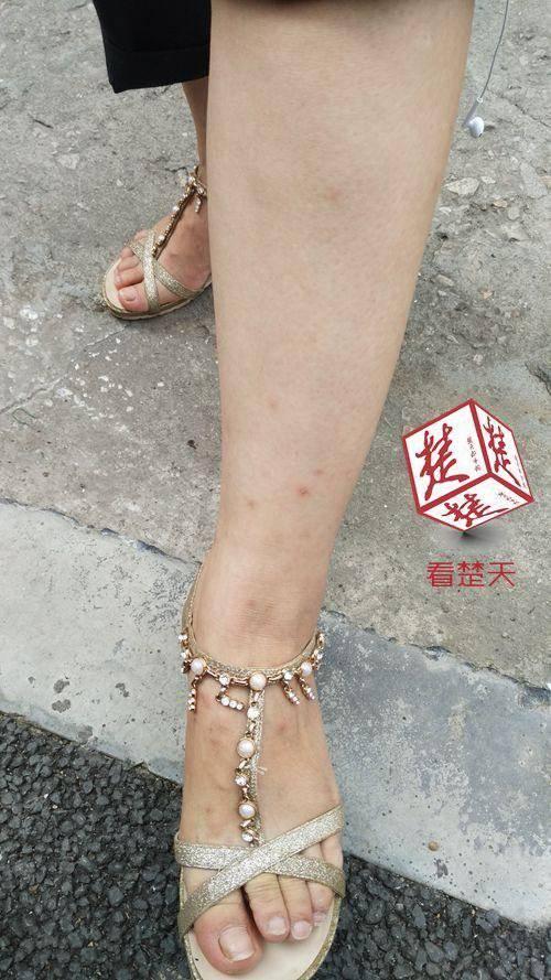 武汉一小区跳蚤肆虐 揭楼栋里为何会出现跳蚤?