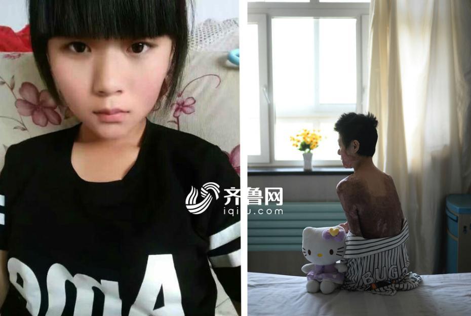 "00后"少女重度烧伤 病床上做直播鼓励病友 (4)