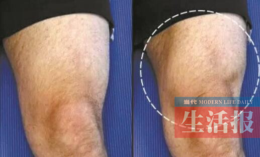 股四头肌等长收缩训练●动作要求:膝关节伸直时绷紧大腿肌肉,持续5-10