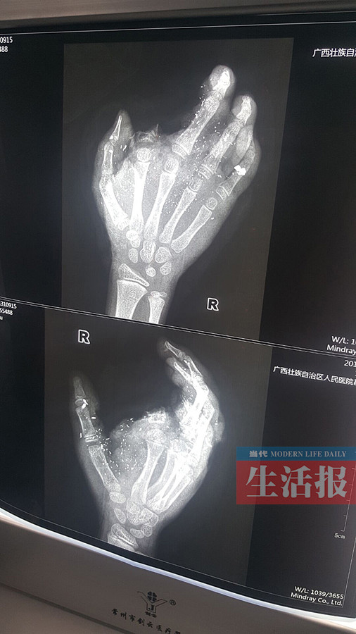 手机充电时发生爆炸 炸飞12岁男孩一个手指(组图)