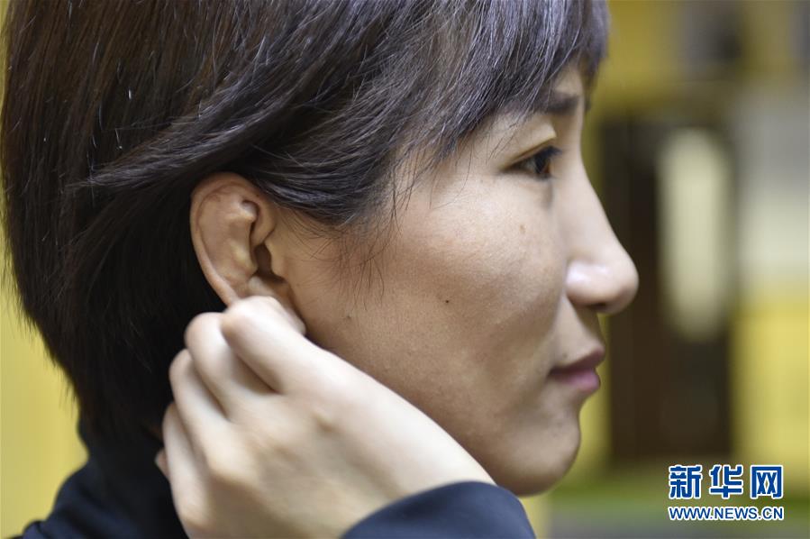 这是1月22日,于萍整理头发时露出右耳,这是典型的"摔跤耳",是常年从事