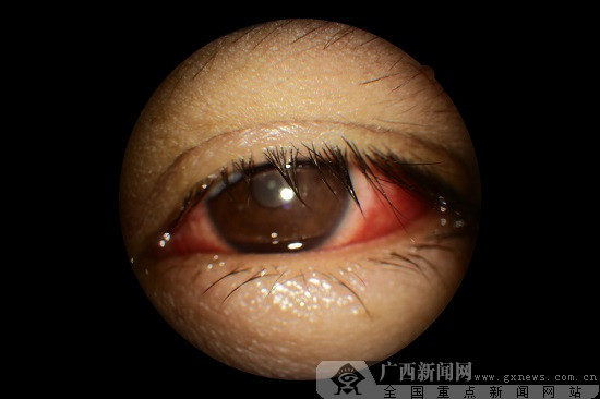 红眼病高发,柳州市眼科医院呼吁早诊早防范