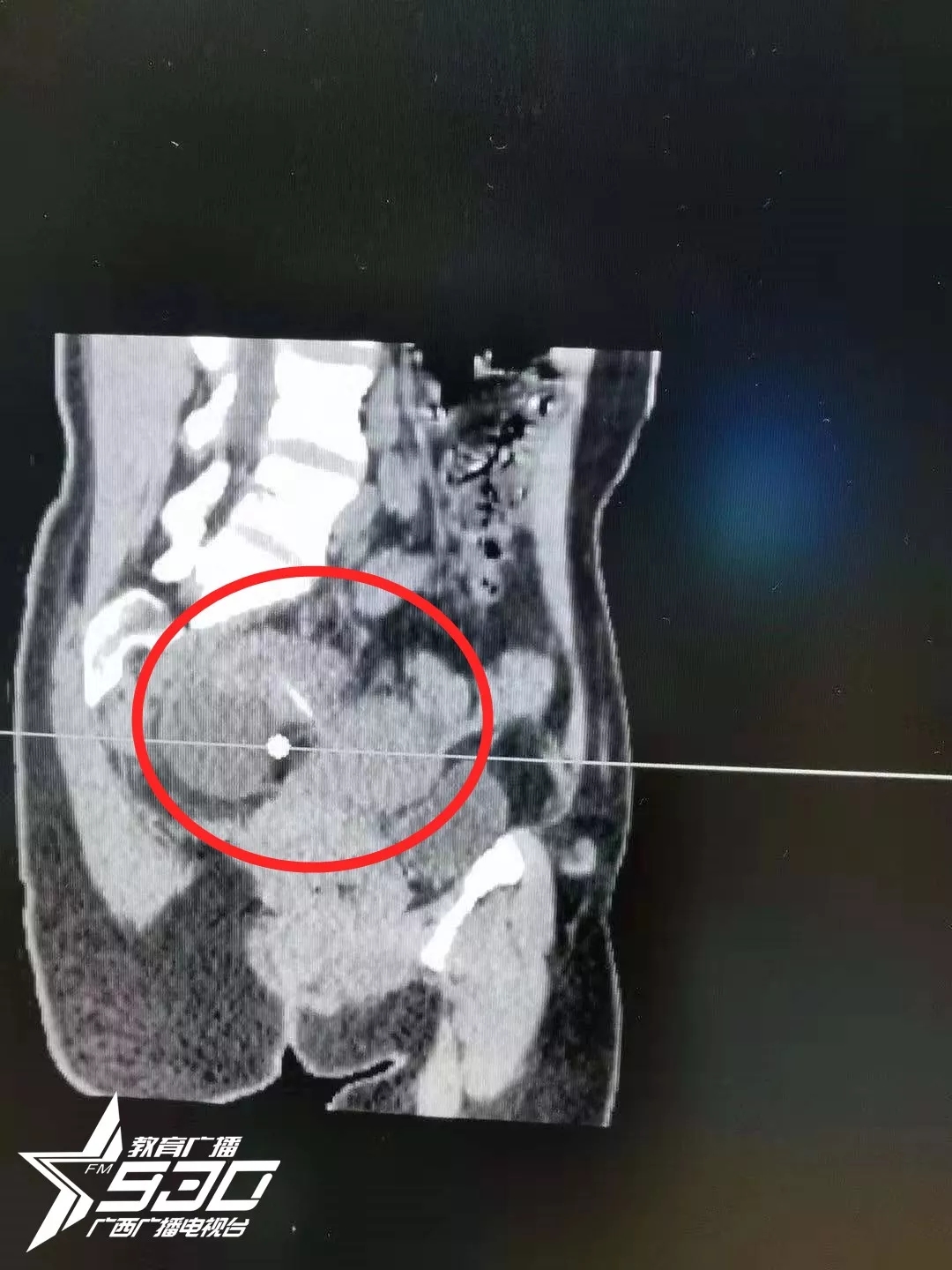 郭伟堃给梁女士照了b超,仔细检查发现:原来直肠里有一根细长的牙签