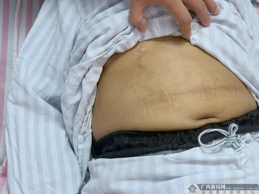 广西的老烂腿：医院如何帮助患者走出困境