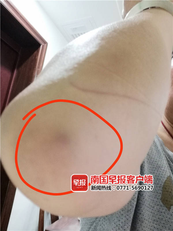 潘女士被摔伤的手臂.南国早报客户端记者 经小飞摄